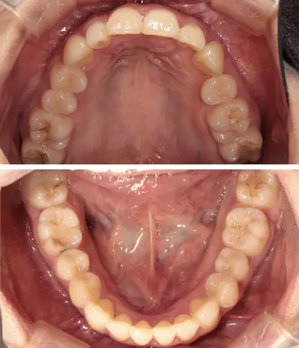 軽度（前歯6本以内）のマウスピース矯正をした症例 治療後