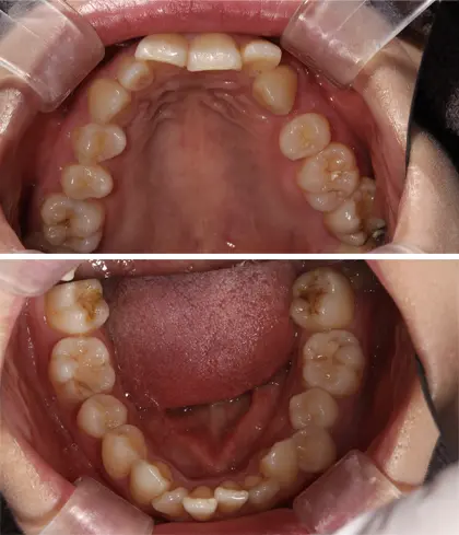 軽度（前歯6本以内）のマウスピース矯正をした症例 治療前