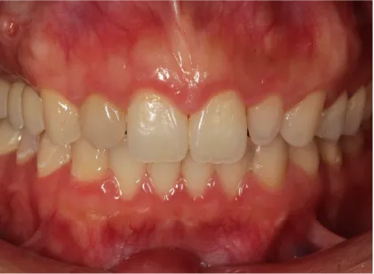 前歯のすき間をマウスピースで矯正したマウスピース矯正の症例 治療後
