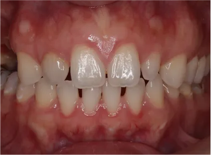 前歯のすき間をマウスピースで矯正したマウスピース矯正の症例 治療前