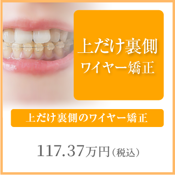 上だけ裏側のワイヤー矯正